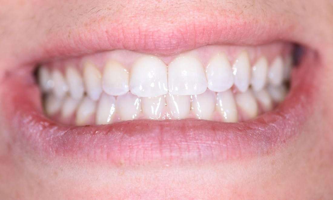 after diastema closure midline