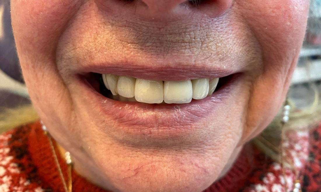after front teeth 2 implants