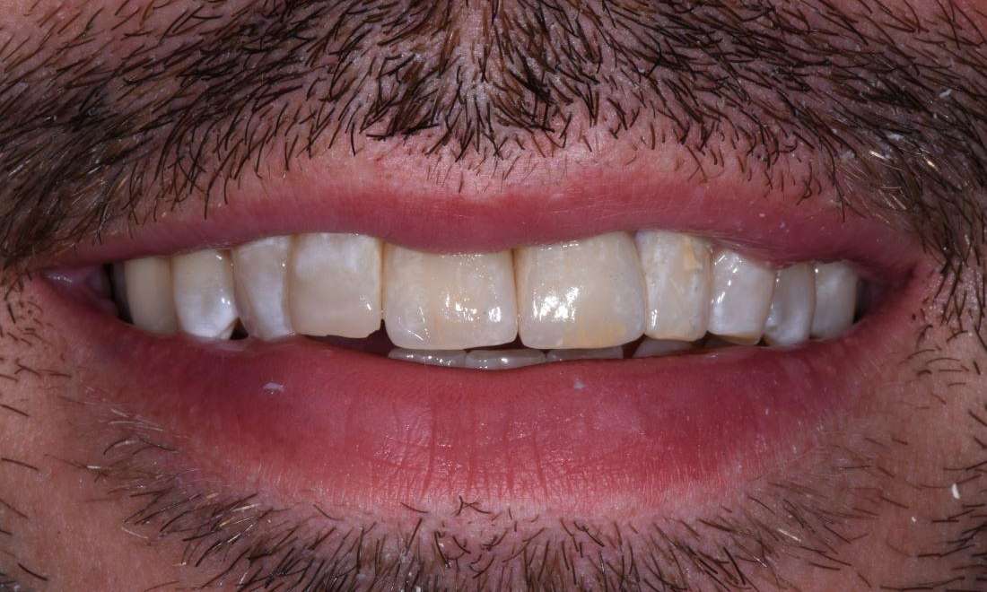 after front teeth implant and crown