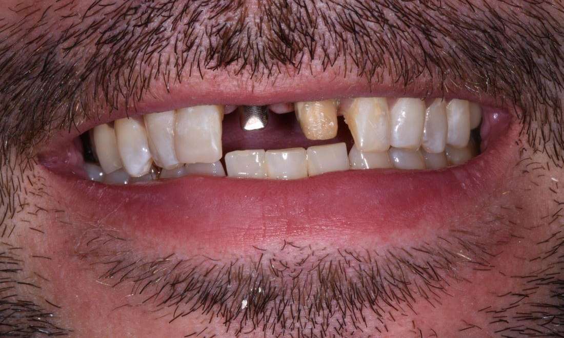 before front teeth implant and crown