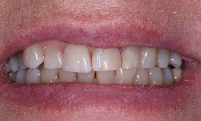 bonding front tooth
