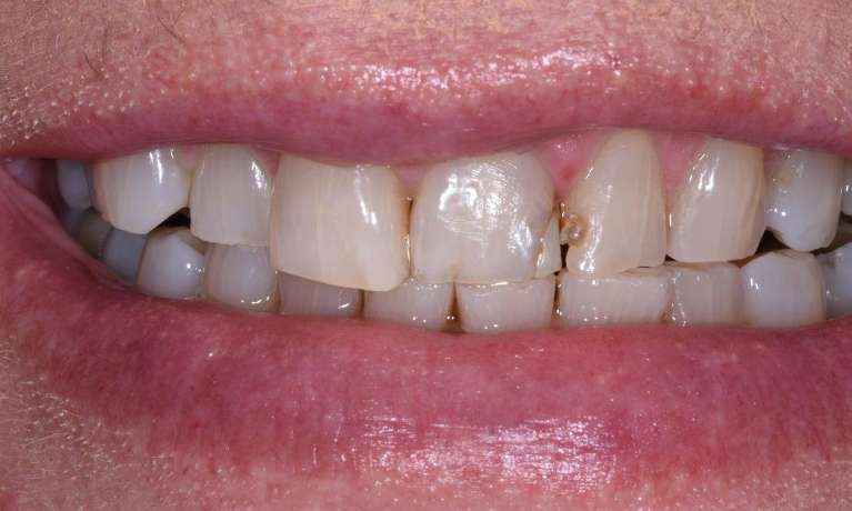 bonding front tooth