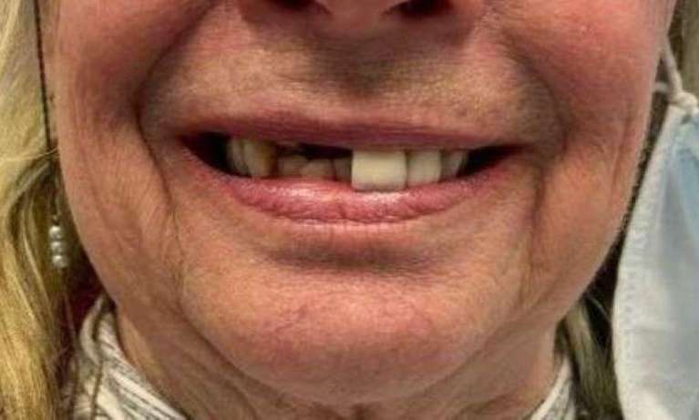Two-Front-Teeth-Implants-Before-Image